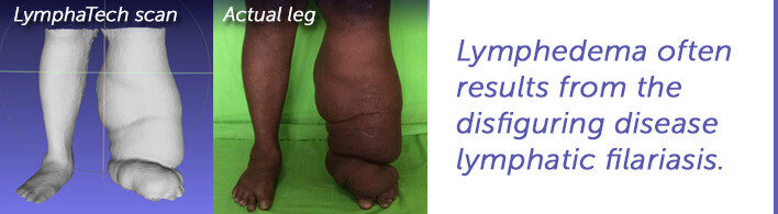 LymphaTech scan and actual leg
