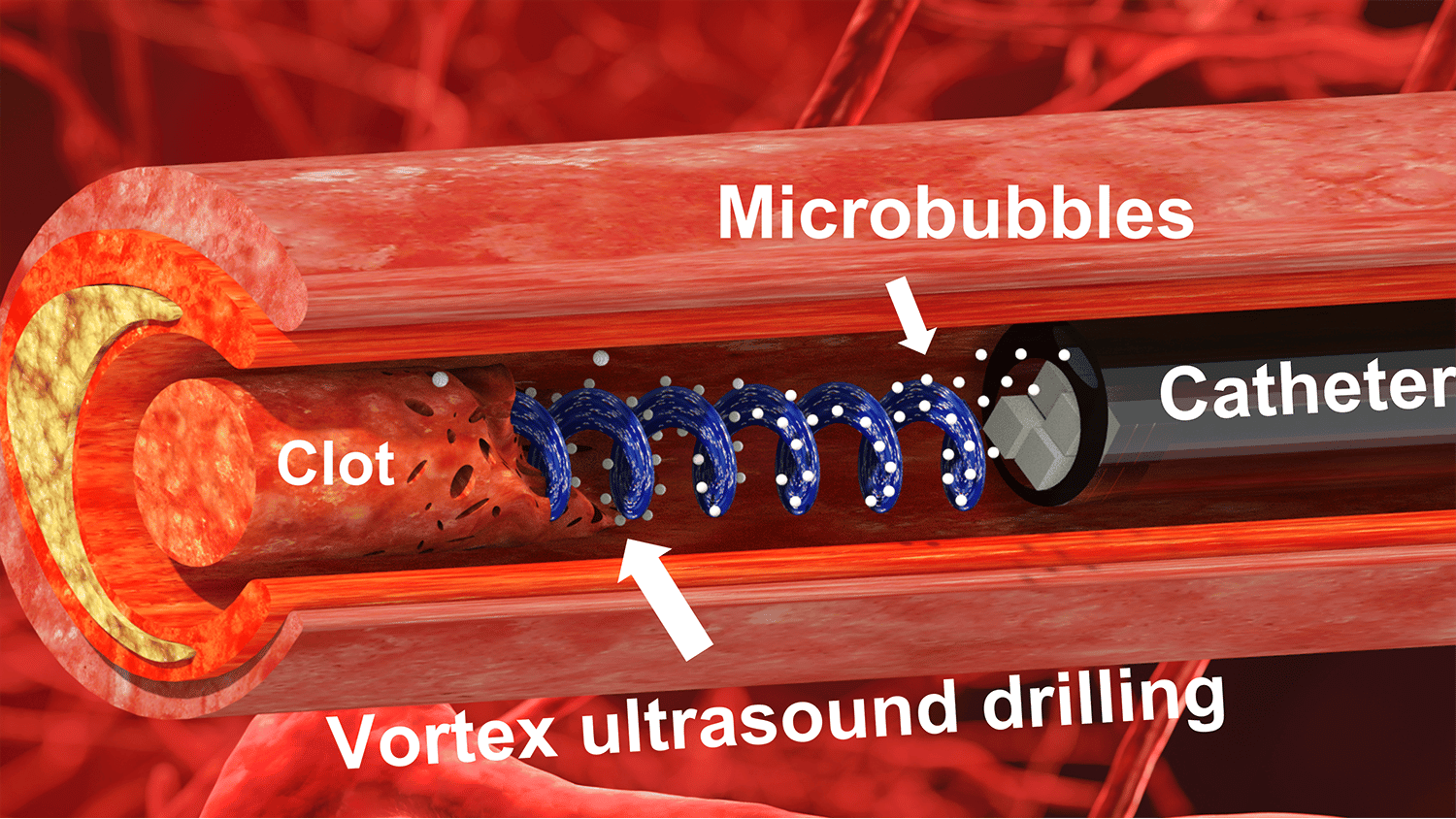 New Tool Uses Ultrasound ‘Tornado’ to Break Down Blood Clots