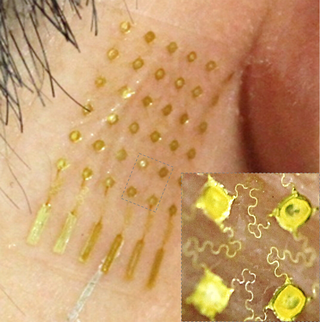 An aerosol-jet printed stretchable, skin-like electrode with an open-mesh structure shown in inset. (Courtesy of Woon-Hong Yeo) An aerosol-jet printed stretchable, skin-like electrode with an open-mesh structure shown in inset. (Courtesy of Woon-Hong Yeo)